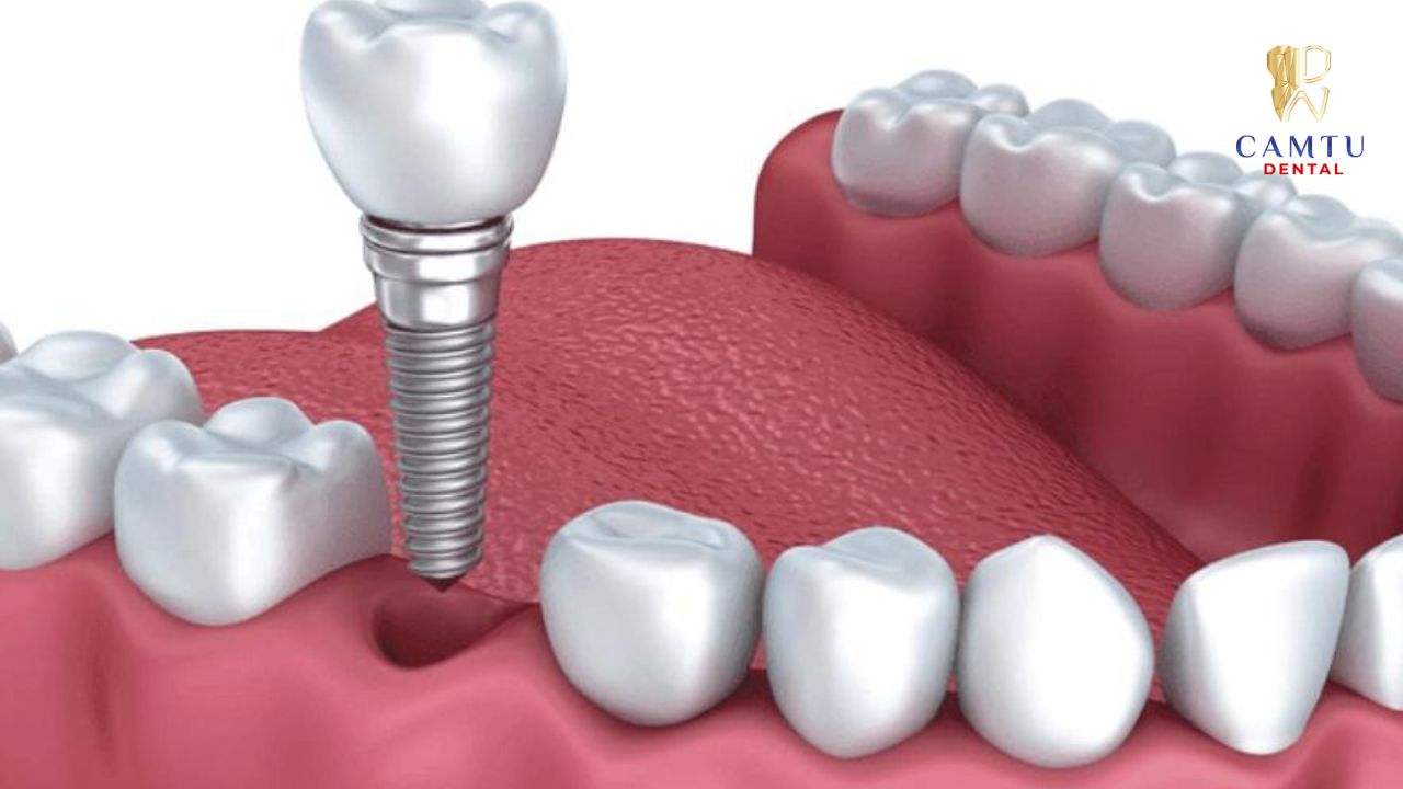 Sơ đồ cấu tạo răng Implant chi tiết tại Nha Khoa Cẩm Tú