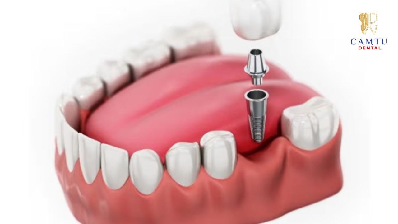 Mô phỏng chân răng Implant tích hợp trực tiếp vào xương hàm