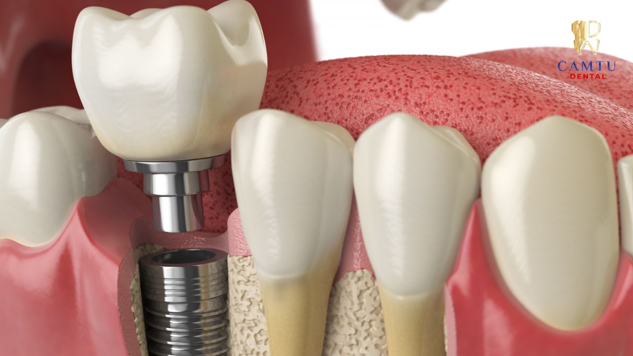 Dịch vụ trồng răng Implant chất lượng cao tại Nha Khoa Cẩm Tú