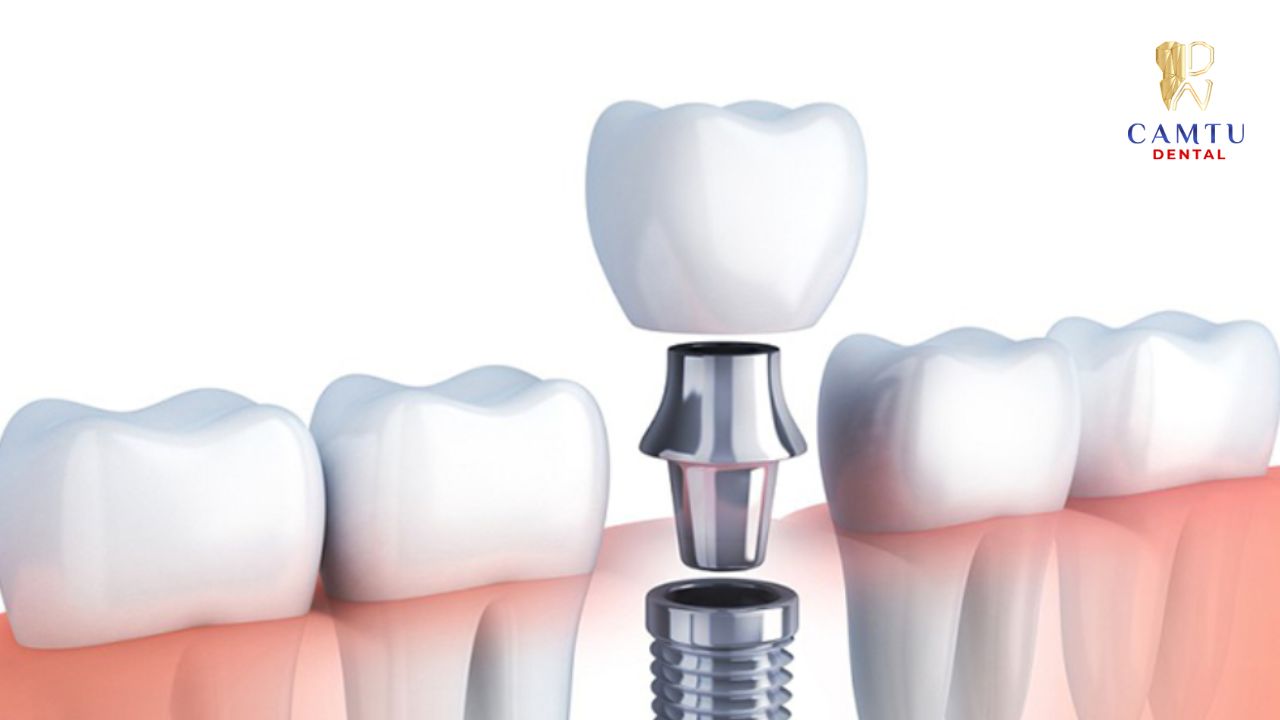 Tái khám răng Implant định kỳ tại Nha Khoa Cẩm Tú