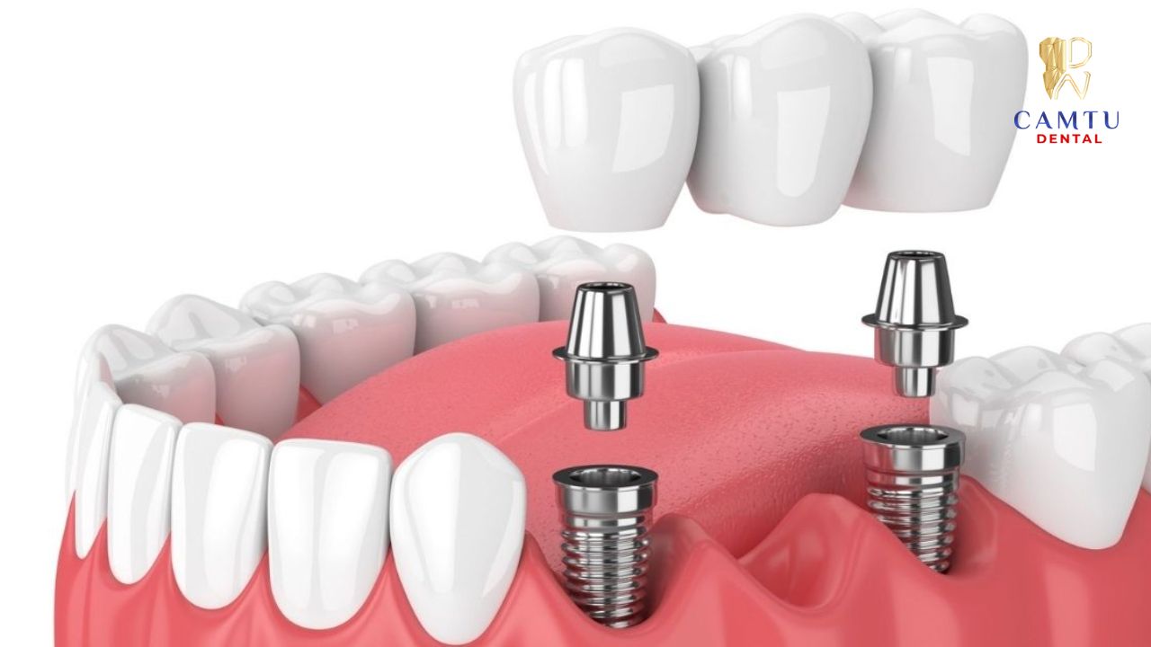 Lý do cần tái khám răng Implant định kỳ theo lịch hẹn bác sĩ