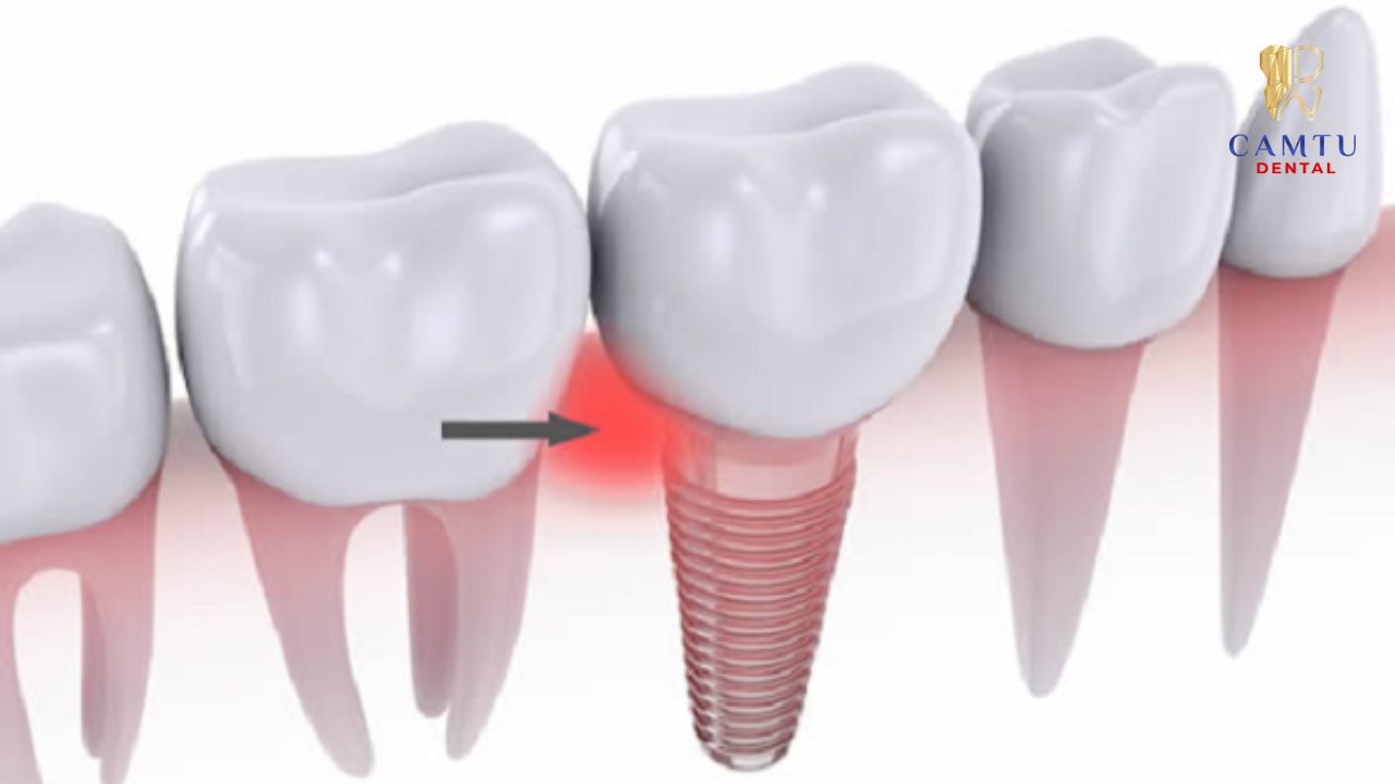 Tăng nguy cơ viêm quanh implant