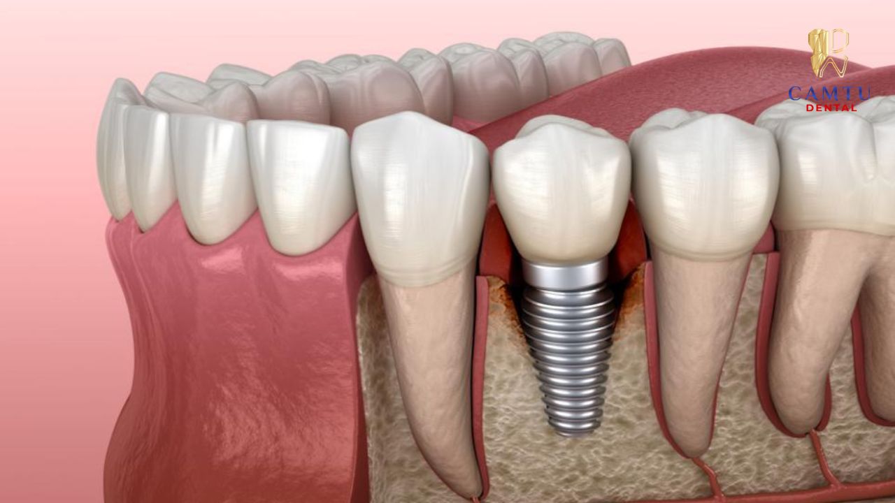 Ảnh hưởng đến tuổi thọ implant