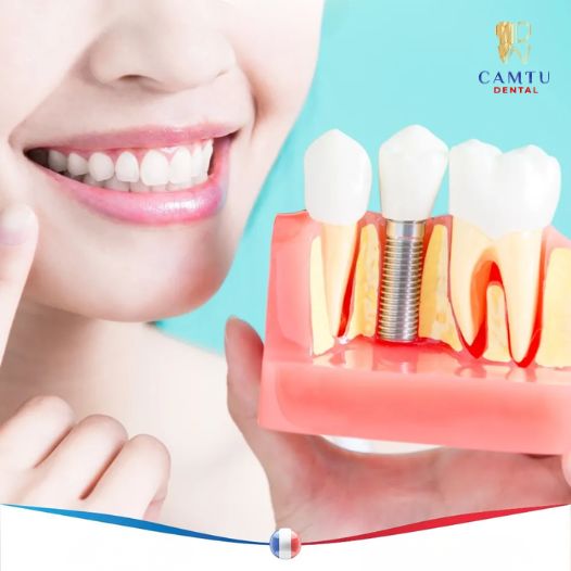 Trồng Implant bao lâu thì lành? Timeline hồi phục chi tiết từ A–Z
