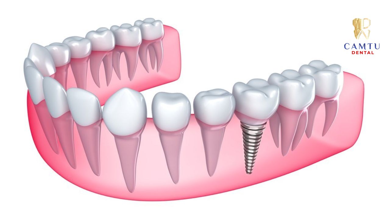 Sau khoảng tuần đầu tiên thì cảm giác đau và ê nhứt sẽ giảm dần