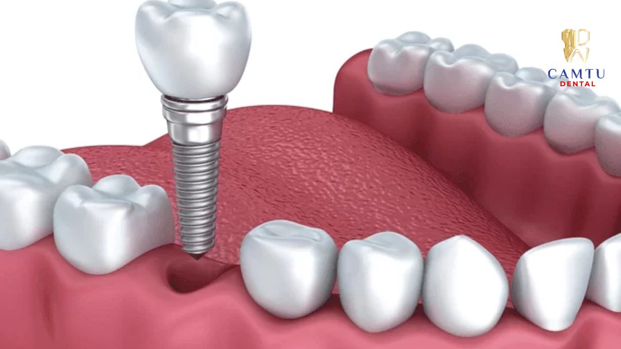 Tình trạng của xương hàm là một trong những yếu tố đầu tiên