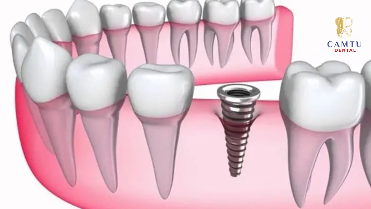 Khi implant tích hợp xương thì có thể gắn sứ sau khoảng vài tuần đến vài tháng