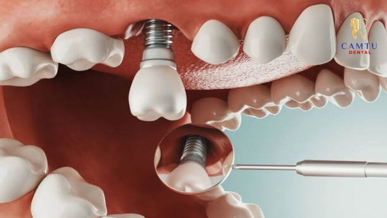 Implant phục hồi tốt thường có độ ổn định cao