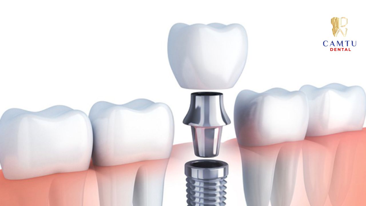 Khoảng thời gian phục hồi sau khi cấy ghép implant