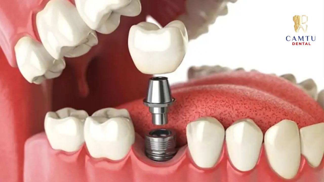 Implant khoảng thời gian từ 2 tháng trở lên mới dần tích hợp xương