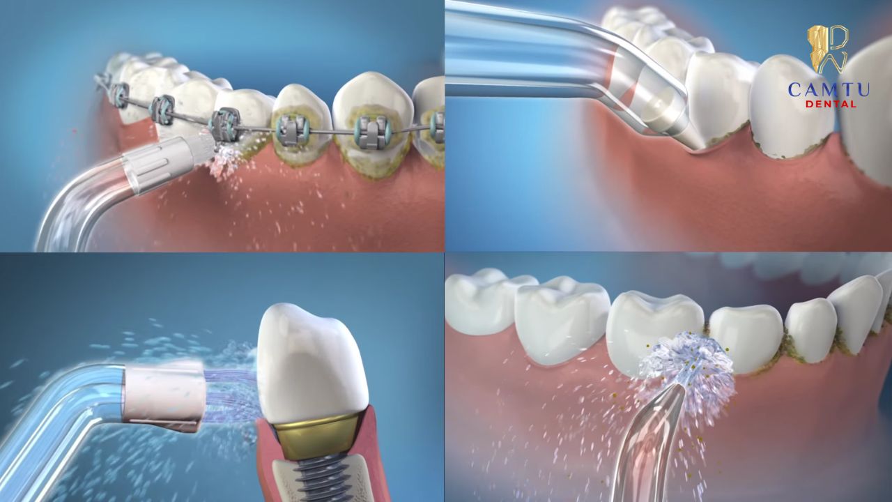 Hướng dẫn vệ sinh răng miệng cho người niềng răng