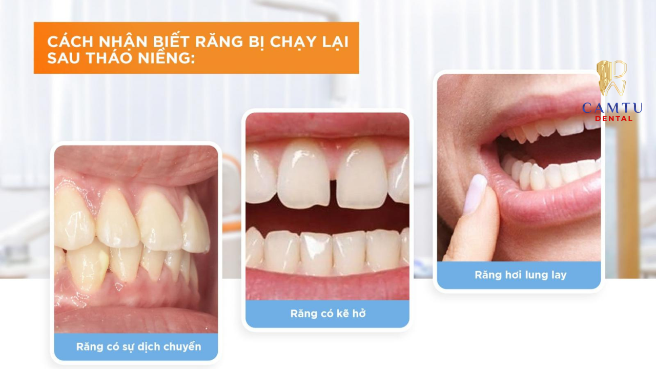 Phát hiện sớm dấu hiệu răng chạy lại giúp can thiệp kịp thời và bảo vệ kết quả