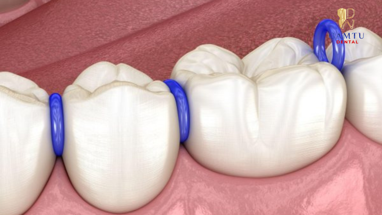 Thun tách kẽ giúp tạo khoảng trống giữa các răng trước khi gắn mắc cài
