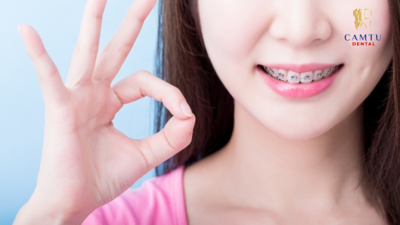 Niềng răng có thể gây ê nhẹ khi răng bắt đầu dịch chuyển