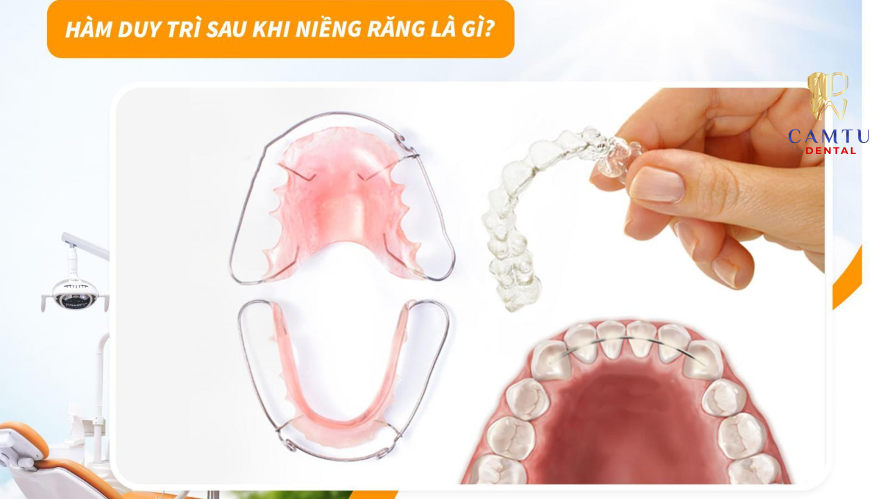 Hàm duy trì giúp giữ răng ổn định sau niềng, hạn chế răng chạy lại