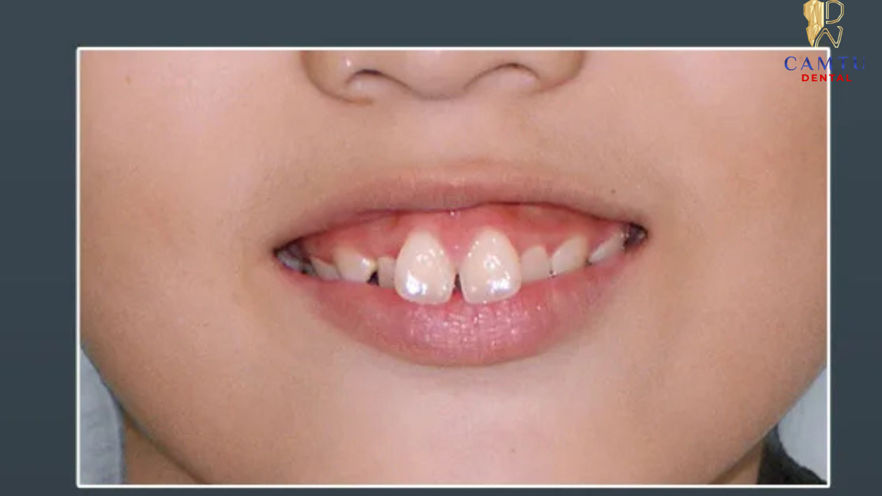 Dấu hiệu nhận biết khi nào cần niềng răng 