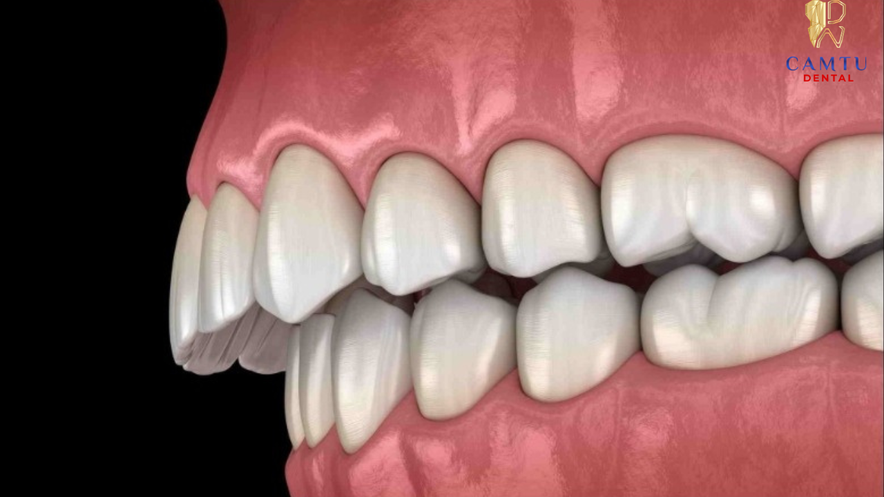Răng hô, vẩu là một trong những dấu hiệu phổ biến cần thăm khám chỉnh nha