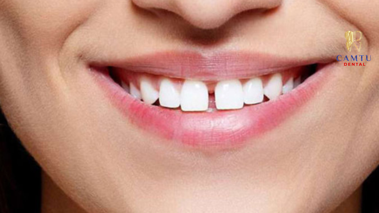 Răng thưa, hở kẽ ảnh hưởng đến thẩm mỹ và khả năng vệ sinh răng miệng 