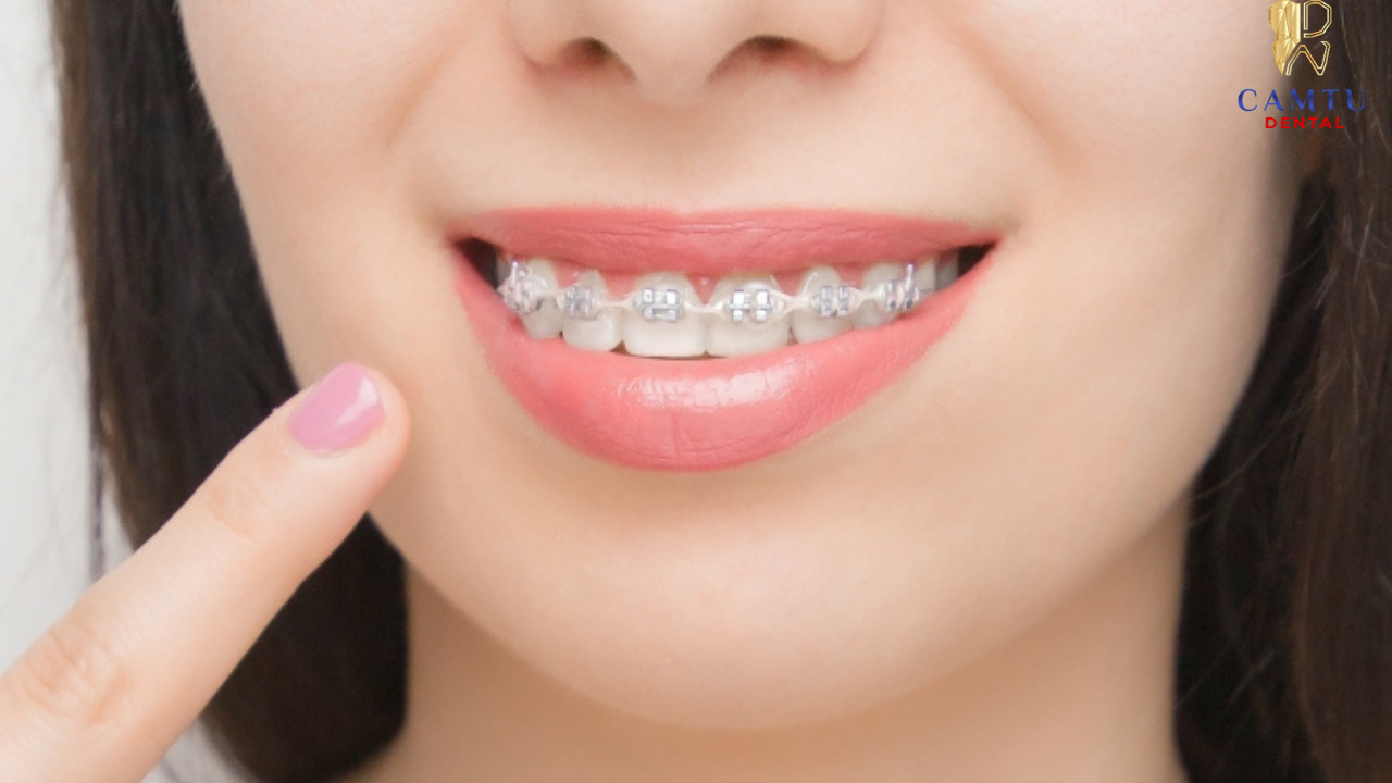Mắc cài tự buộc giúp giảm ma sát và tăng sự thoải mái khi chỉnh nha
