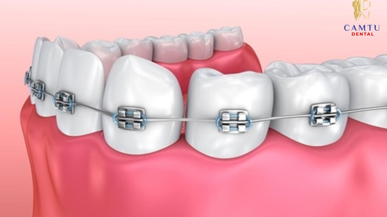 Nhổ răng đúng chỉ định giúp tạo khoảng khi niềng