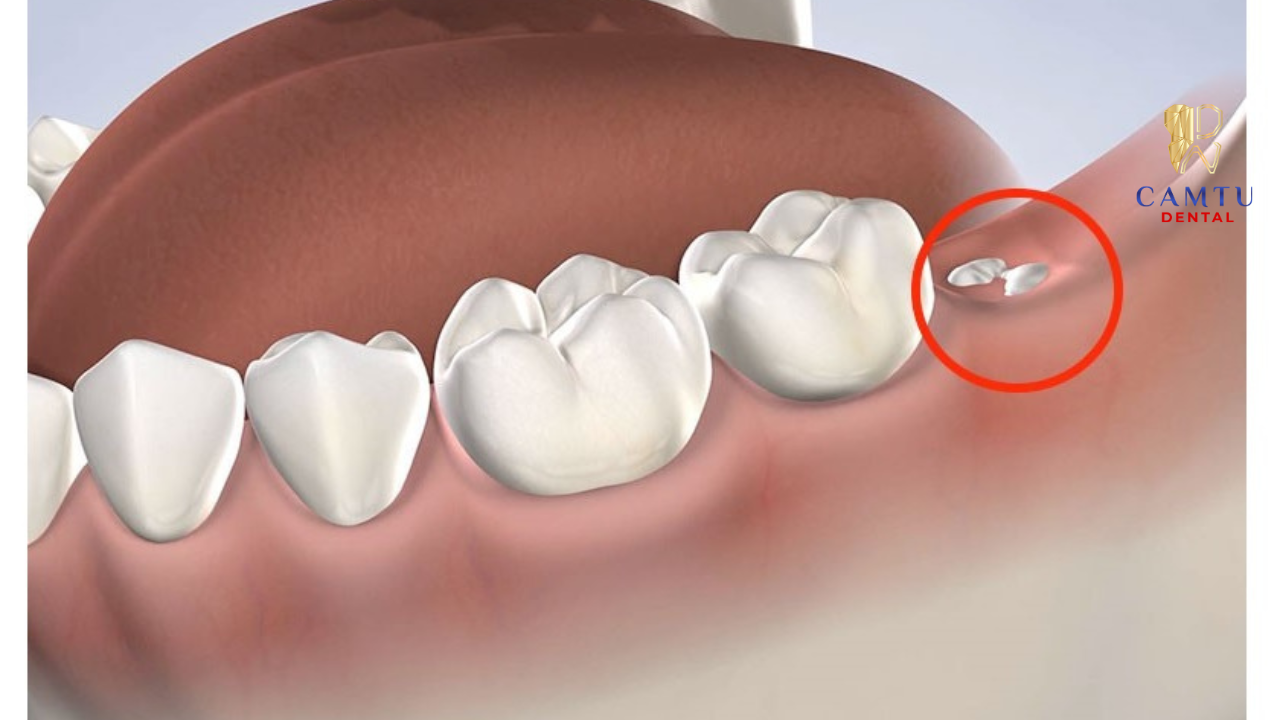 Vị trí nhổ răng được bác sĩ chỉ định theo từng trường hợp
