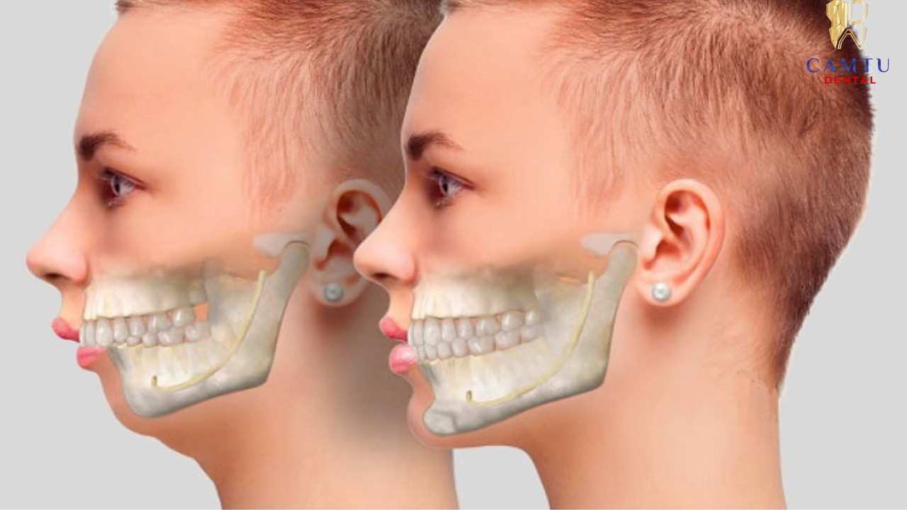Mắc cài và dây cung tạo lực kiểm soát giúp răng dịch chuyển dần về vị trí mong muốn.