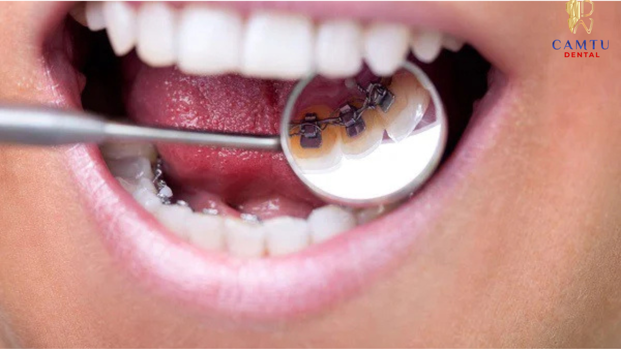 Sau khi tháo niềng, răng vẫn có xu hướng dịch chuyển nên cần chăm sóc