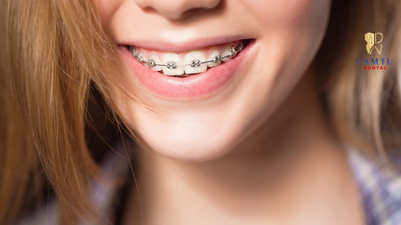 Sau khi tháo niềng, hãy đeo hàm duy trì đúng chỉ định và tái khám đúng hẹn