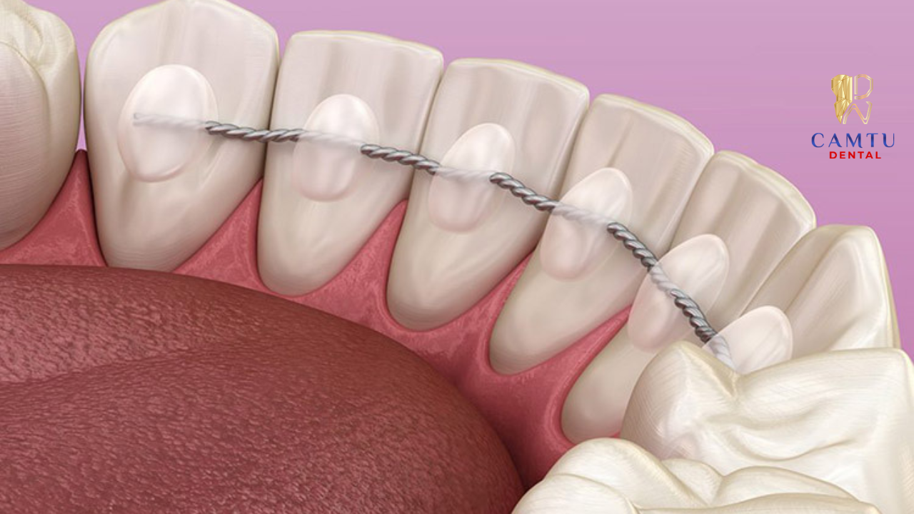 Thời gian đeo hàm duy trì tùy tình trạng răng và chỉ định của bác sĩ