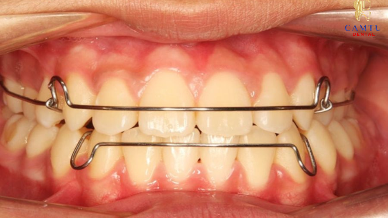 Hàm duy trì kim loại bền, chắc và có thể điều chỉnh, nhưng tính thẩm mỹ thấp
