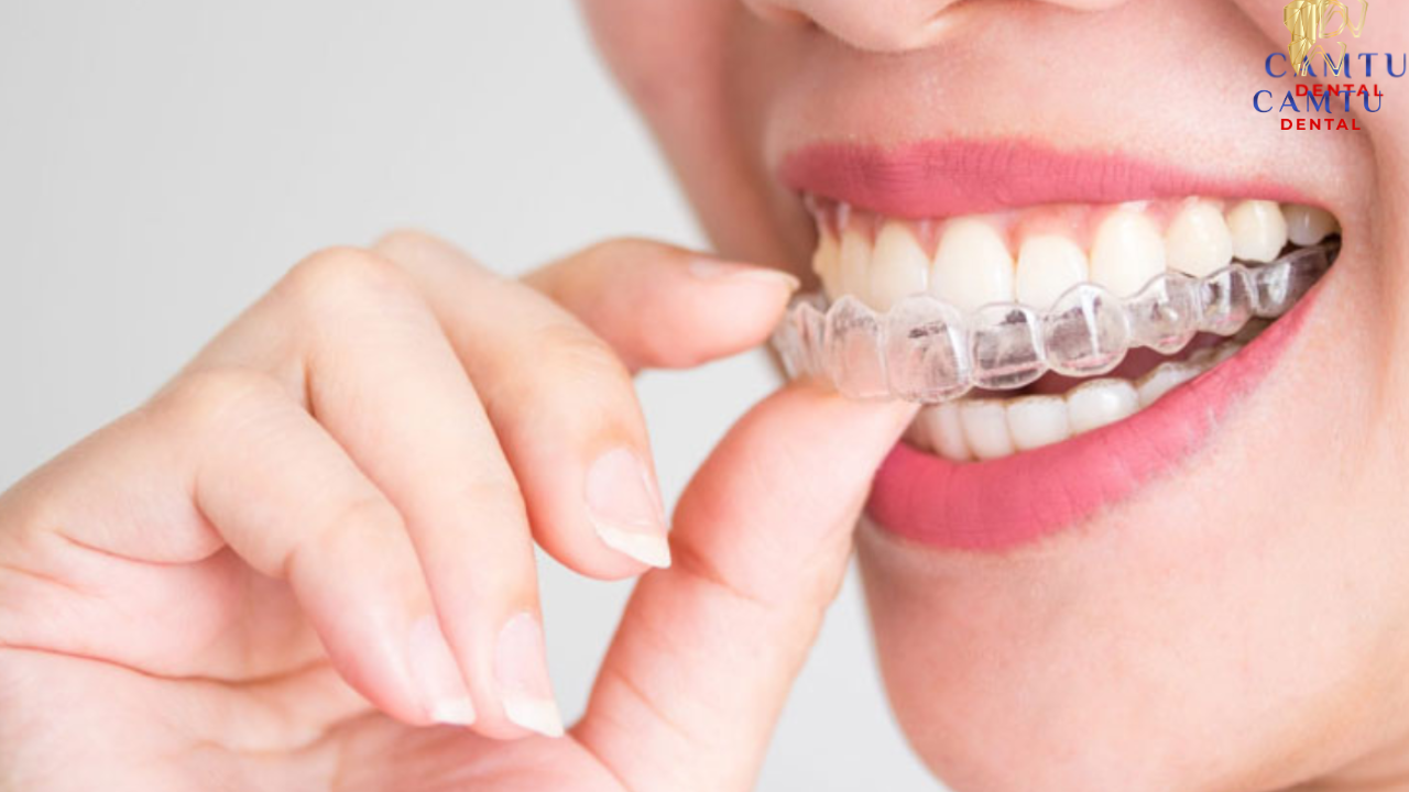 Khay niềng trong suốt tạo lực nhẹ nhàng giúp răng dịch chuyển theo từng giai đoạn