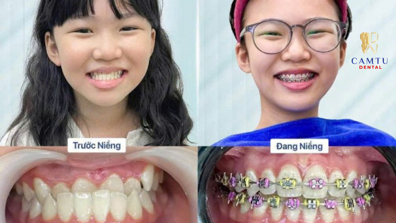 Niềng răng sớm không chỉ giúp cải thiện khớp cắn mà còn hỗ trợ định hướng răng