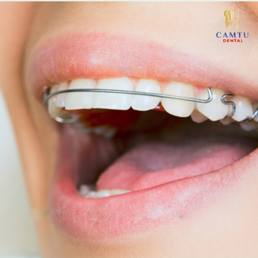 Hàm duy trì sau niềng là gì