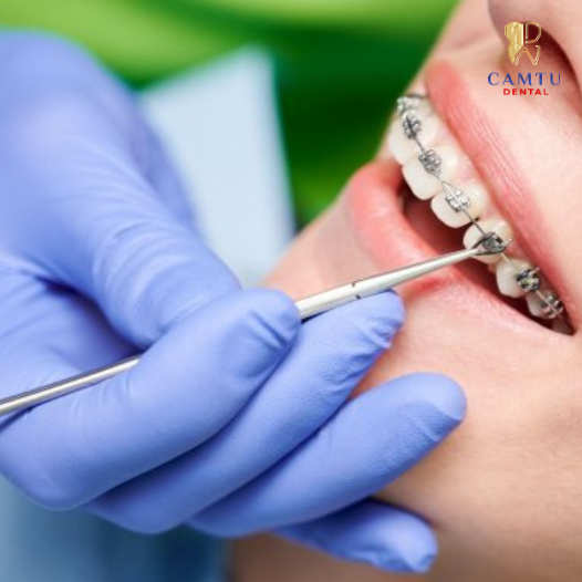 Gắn mắc cài là gì