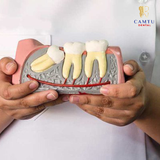Niềng răng cần nhổ răng không