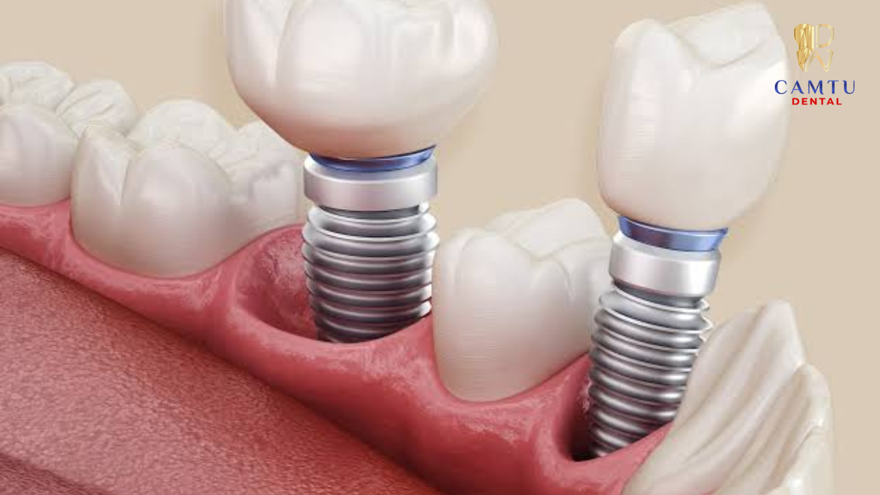 Thiết kế chuẩn xác cho từng khoảng trống răng