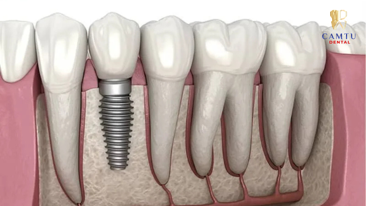 Implant Mỹ – Tốt nhất khi đúng chỉ định
