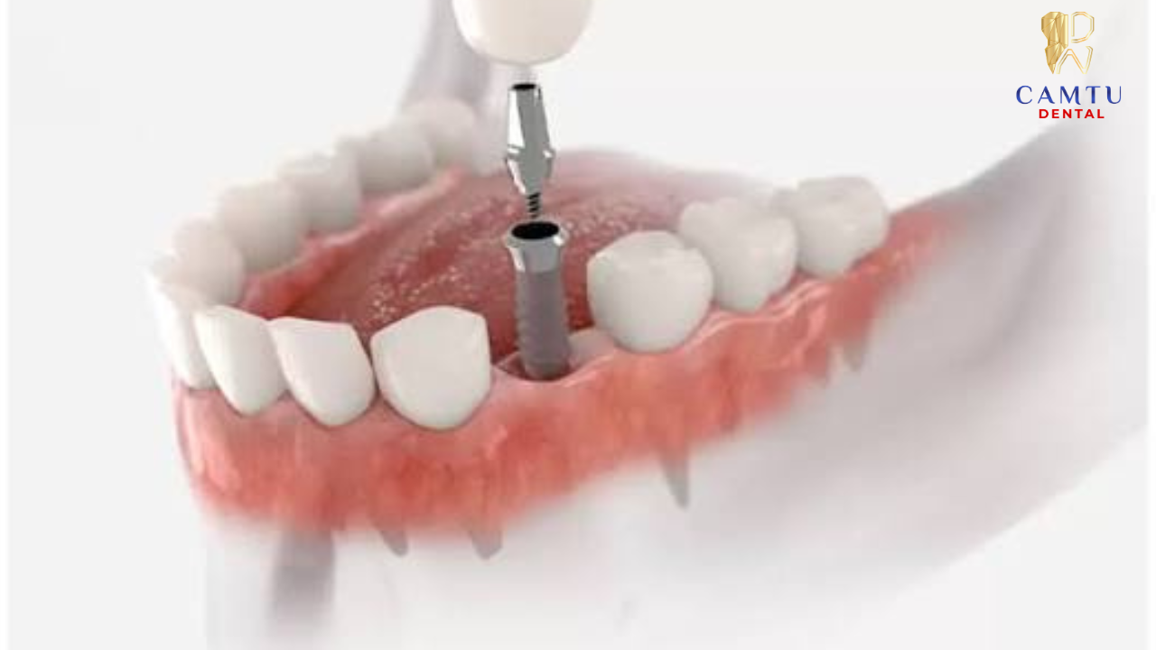 Không chỉ chọn trụ, tuổi thọ Implant phụ thuộc vào đâu