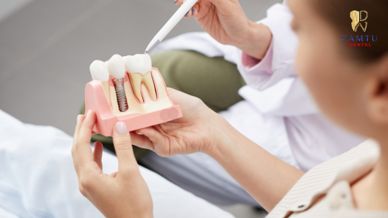 Thiết kế Implant Mỹ – Tối ưu độ tích hợp xương