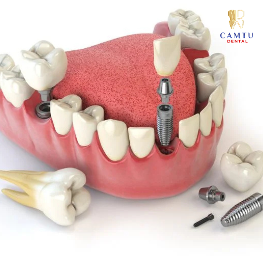 implant Hàn Quốc