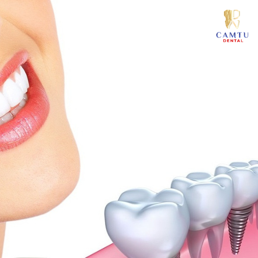 implant Mỹ